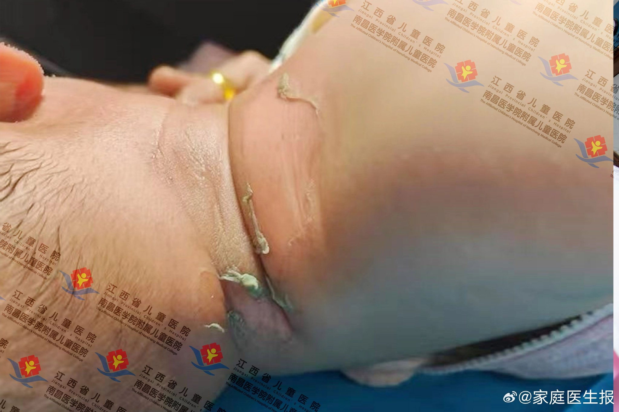 冬季婴幼儿鼻塞勿用开水熏蒸，多名婴儿烫伤送医