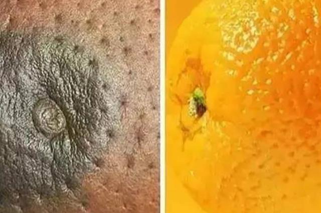 乳晕周围有小疙瘩,他们说这是毒素堆积