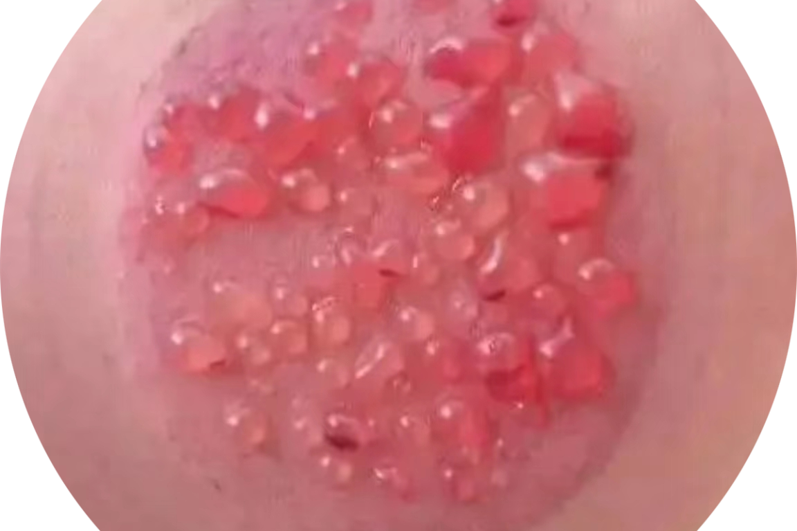 在这里我想说的是拔罐儿出水泡应该是好现象,你体内的病邪通过拔罐儿