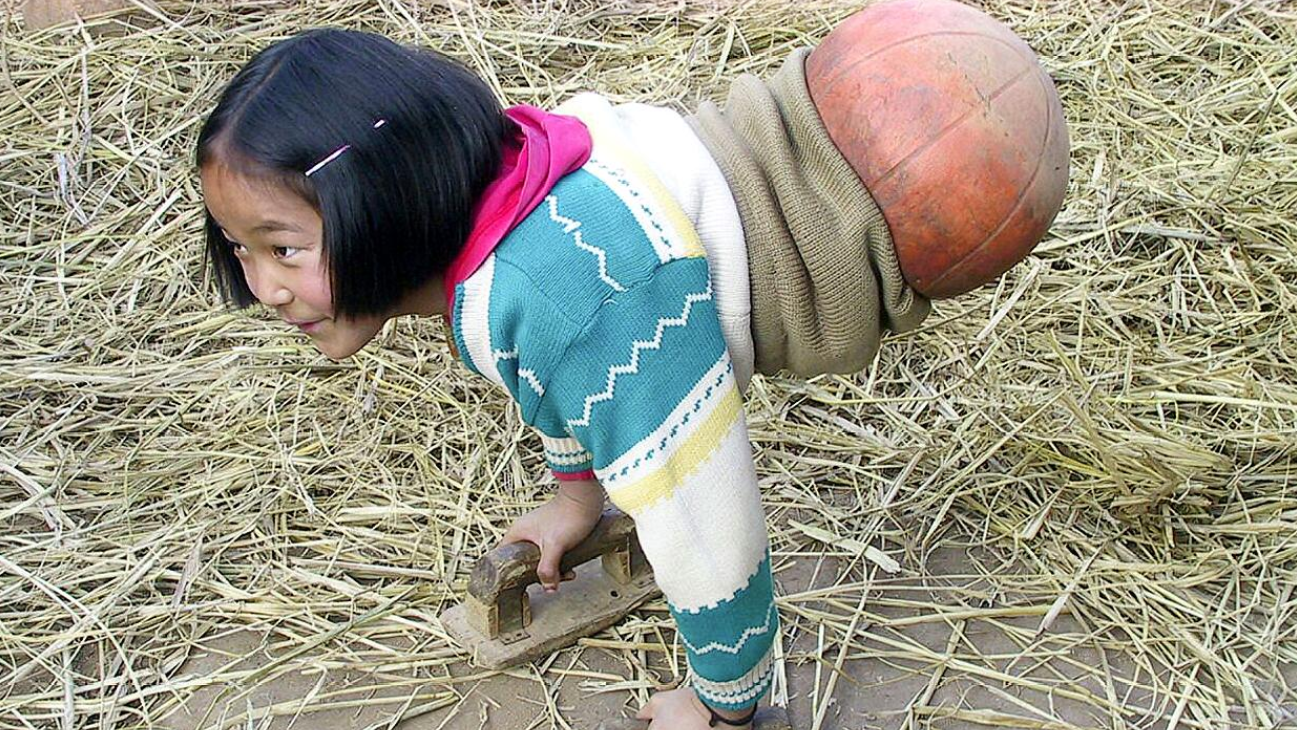 励志无腿女孩靠篮球走路 屡夺游泳冠军