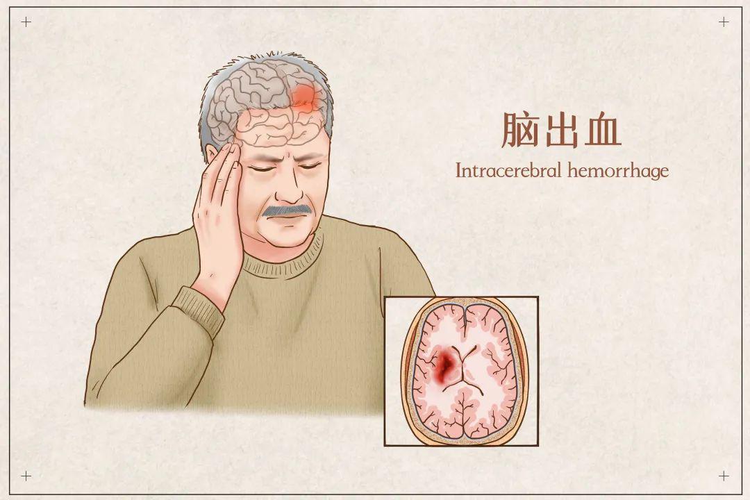 每分钟死亡190万脑细胞,「FAST」口诀教你判断中风前兆|中风|脑卒中|脑中风_新浪新闻