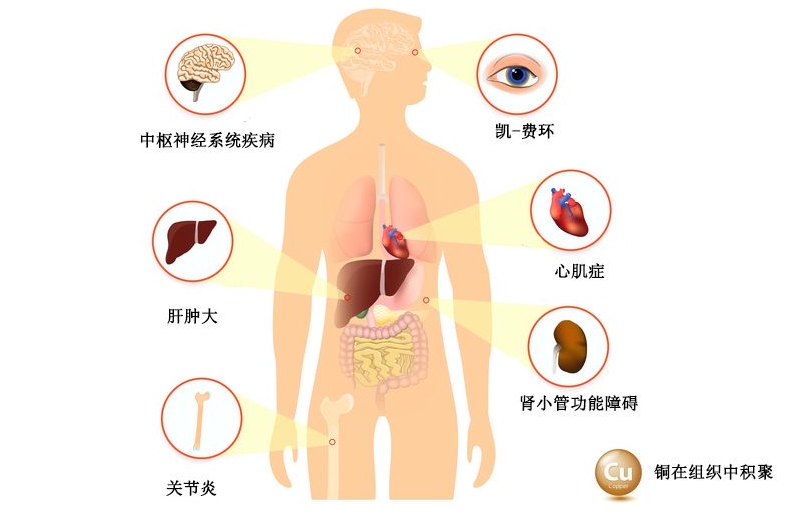 威尔逊病青霉胺替代药！FDA批准Cuvrior(四盐酸盐曲恩汀)|青霉胺|盐酸盐|患者_新浪新闻