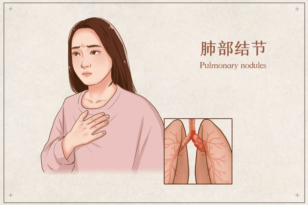 肺结节会引起咳嗽吗 肺结节早期症状有哪些