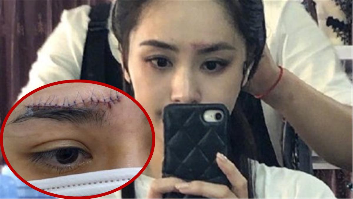 阿娇晒伤口照透露快要痊愈了,眉骨处术后缝针痕迹清晰可见