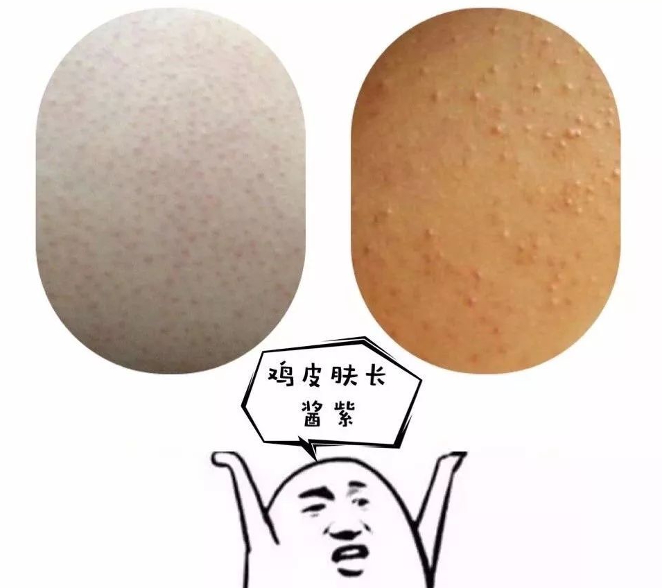 胖子是不是容易长鸡皮肤(胖子是不是容易长鸡皮肤图片) 胖子是不是容易长鸡皮肤(胖子是不是容易长鸡皮肤图片)