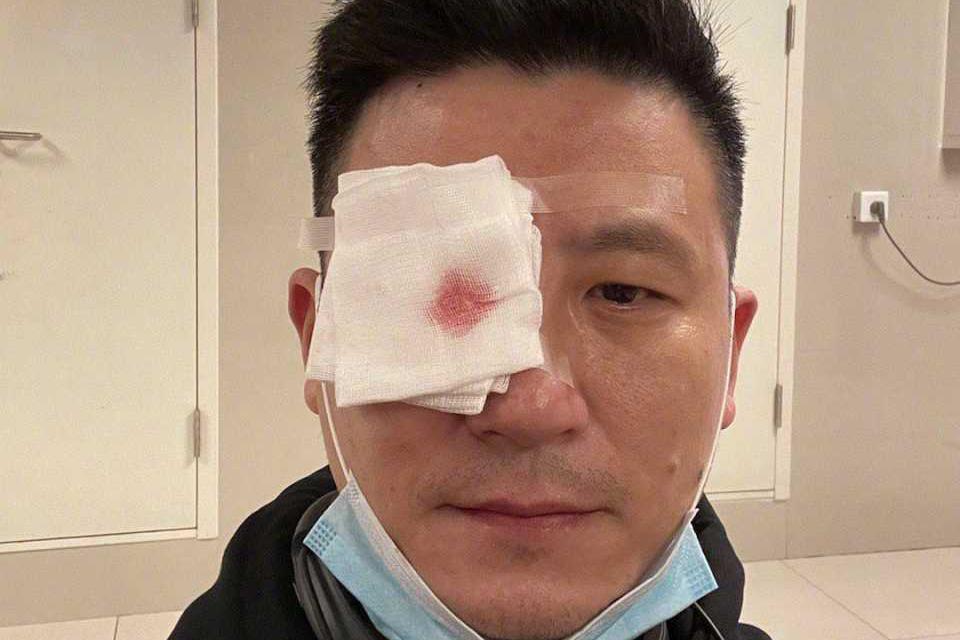 奥运冠军蔡赟右眼意外受伤,血丝渗出竟染红了纱布