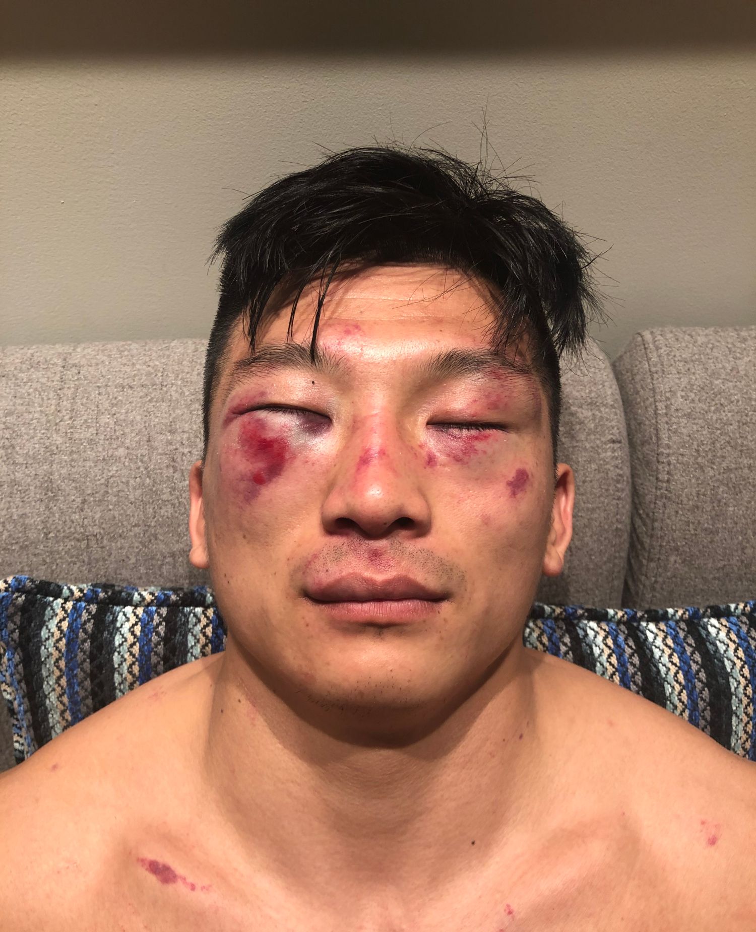 昆仑决最能打的拳王受伤严重,在京遭世界拳王挑战虽打赢却伤势重