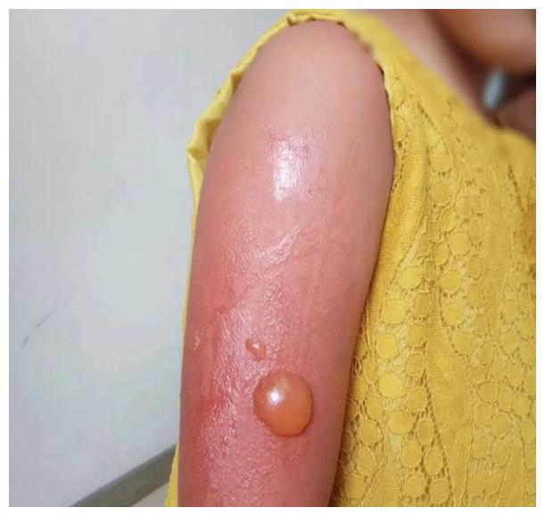 3岁前被晒伤,患癌率会翻倍?宝宝防晒没做好,不止晒黑这么简单