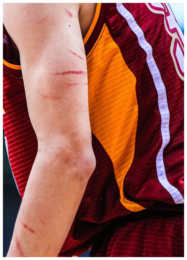 吴前胳膊伤痕引关注,"辽宁贝弗利"一战成名,苏群:感谢外援