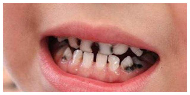 牙齿|宝宝|龋齿_新浪新闻