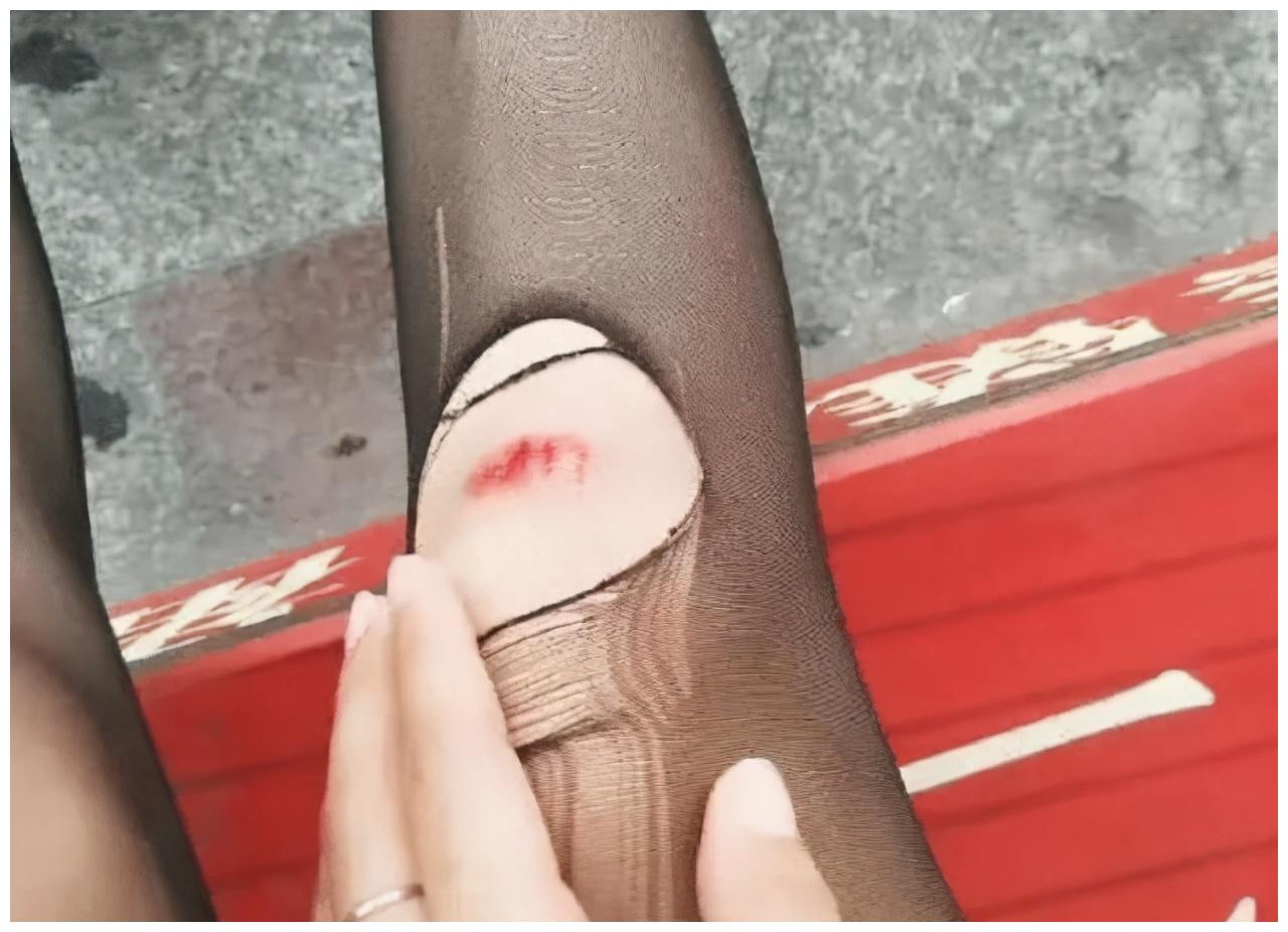 为什么女朋友总摔到膝盖呢一个月都摔十几回了她是不是病了