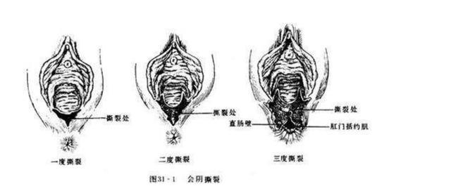 顺产的侧切或撕裂对以后有什么影响医生说的实情是