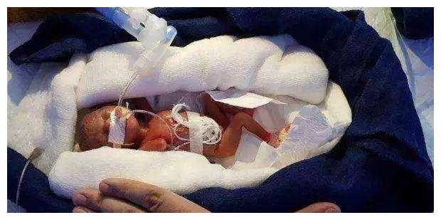 21周大的婴儿出生时仅巴掌大14年后她的现状让人不敢相信