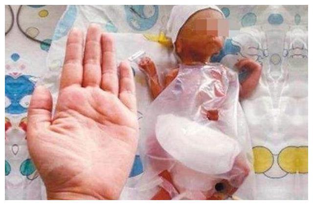 这个"超级早产儿"叫做阿米利娅·泰勒,她在妈妈肚子里仅待了21周,出生