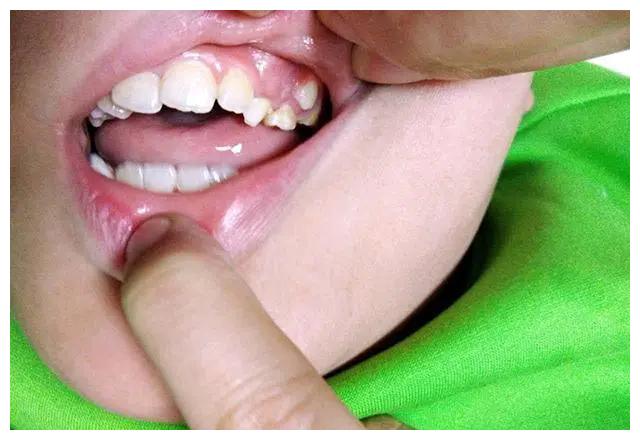 儿童暴牙齿图片