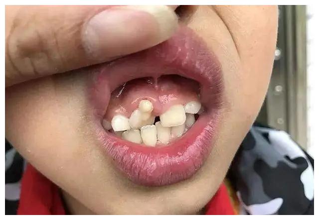 6岁下门牙长成双排牙图片