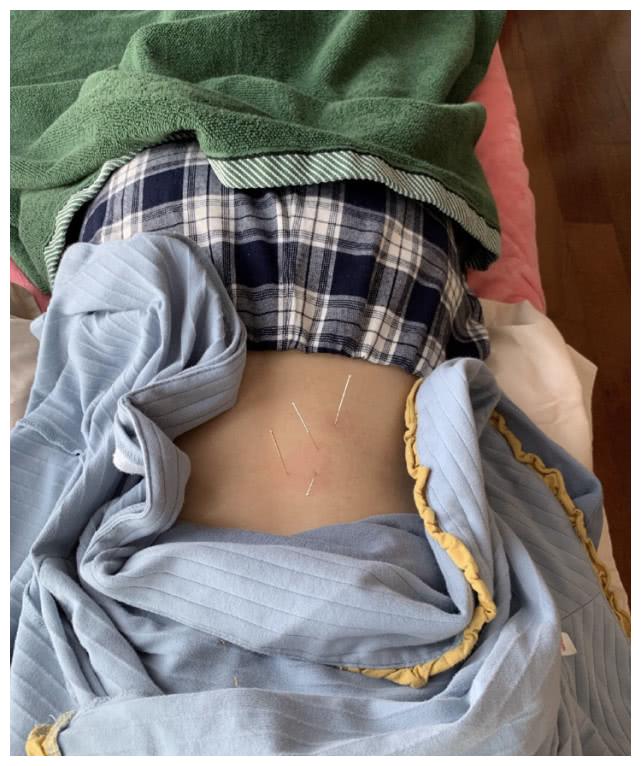 钟楚曦晒针灸近照表露腰韧带损伤,趴在床上不能动弹引粉丝担心