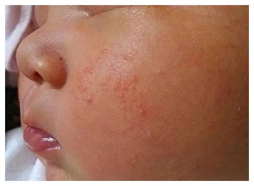 宝宝脸上长了这些, 宝妈急疯, 其实很多新生儿都会长|宝宝|宝妈|湿疹