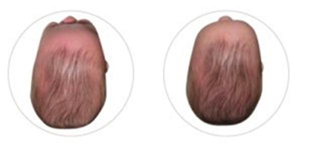 宝宝出现的舟状头是怎么回事