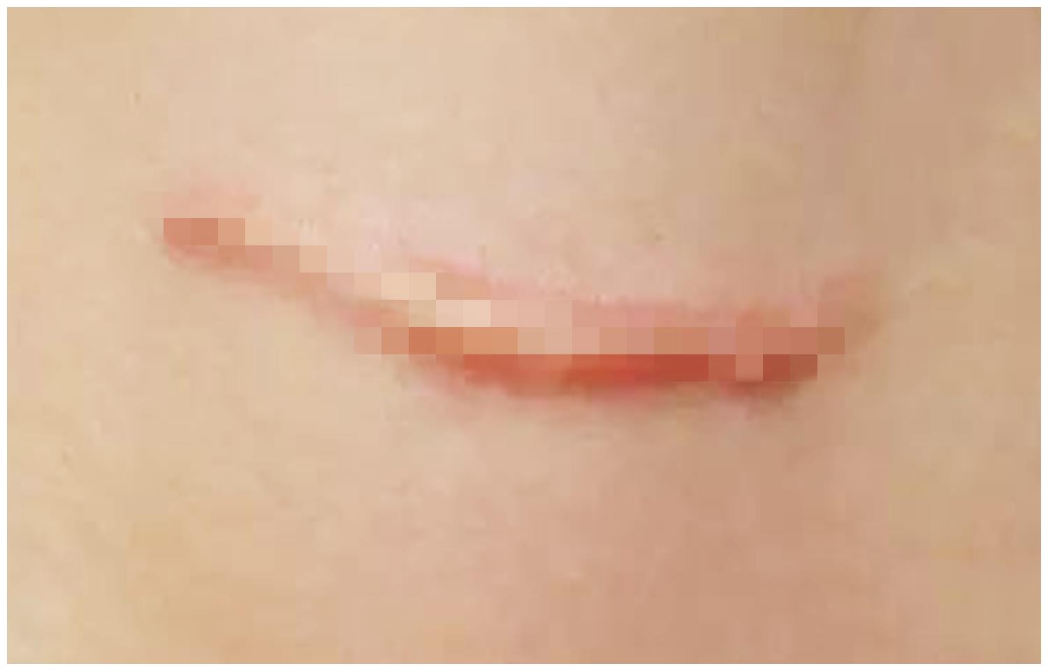 女性疤痕体质有多可怕剖腹产术后看看肚子的伤疤就知道了