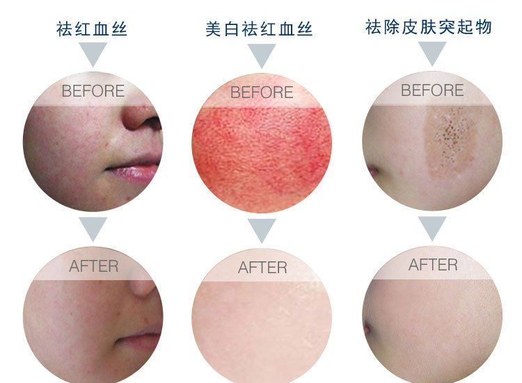 皮肤管理原理:起痘,起斑,红血丝起因!