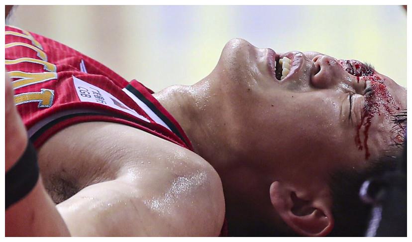 新疆男篮赢球输人品,前cba状元血洒赛场,眼角3厘米伤口缝10针