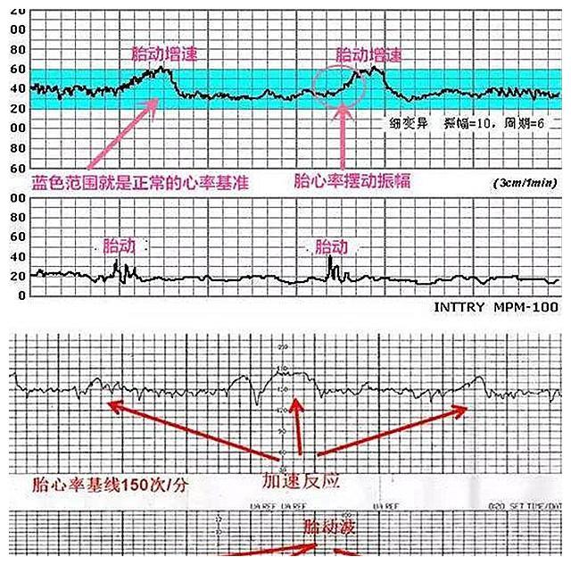 临产前胎心监护越发频繁是否必要胎监顺利通过在于四个技巧