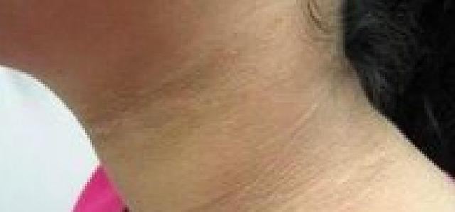 9岁小女孩脖颈发黑洗不掉,经医院检查后,医生的话让家长笑了