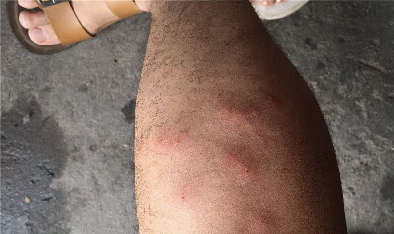 广西辅警抓捕毒犯被红火蚁咬伤意识昏迷三次倒地红火蚁有多毒