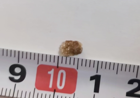 恭喜涞水小伙三天排下输尿管结石