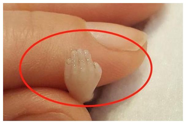 在医生为她做完引产手术以后,这位孕妈要求看一眼从自己肚子里引产的