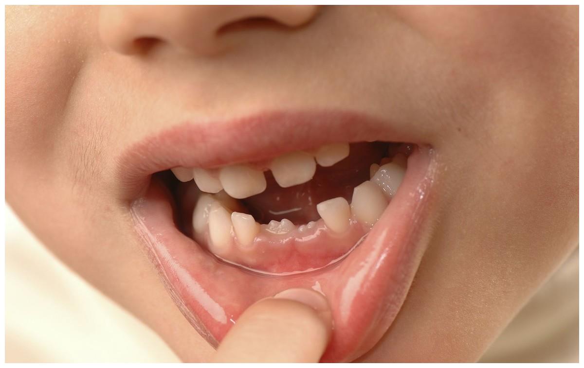 孩子总哭喊牙疼医生双排牙都长坚实了爸妈早干吗去了