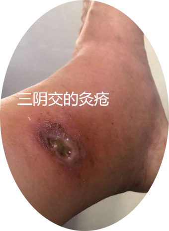 灸疮一发祛病如抓,摘录了几个前辈的文章