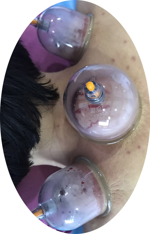 百会穴,大椎穴和风池穴,可以结合点刺放血,以这种方法疏通经络.