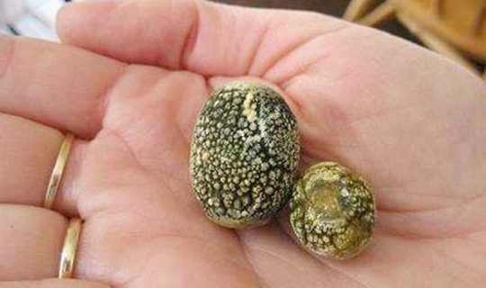 16岁女孩腹痛,查出胆内长满"石头",和常做一件事有关,你有吗|胆结石