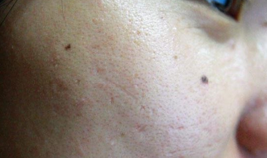 两边也不对称,所以痣不对称需要注意;普通的痣边缘看起来都比较光滑