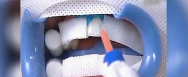 如何让牙齿变白（如何让牙齿变白最简单的方法）-85模板网