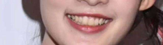 如何让牙齿变白（如何让牙齿变白最简单的方法）-85模板网