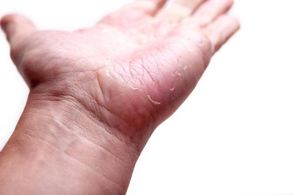 反复出现手脱皮,或是这5个因素导致的,要及时治疗,别忽视休闲区蓝鸢梦想 - Www.slyday.coM 反复出现手脱皮,或是这5个因素导致的,要及时治疗,别忽视休闲区蓝鸢梦想 - Www.slyday.coM