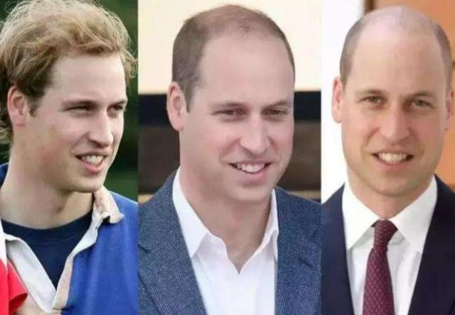 英王室3代被谢顶困扰，哈里王子却头发浓密，网友：随了戴安娜