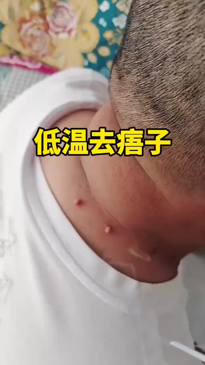 原来痦子还能这样去除。_新浪新闻