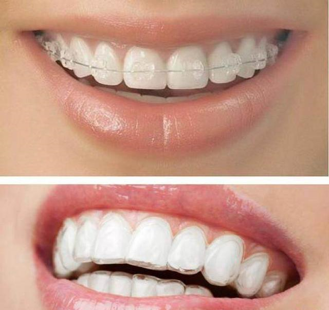 如何让牙齿变白（如何让牙齿变白最简单的方法）-85模板网