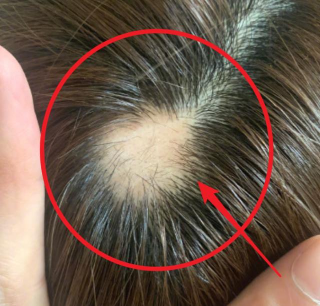 你们觉得沈梦辰斑秃和感情有关系吗