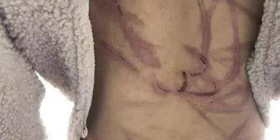 10岁女童遭家暴伤痕累累父母的消极情绪对孩子影响到底有多大