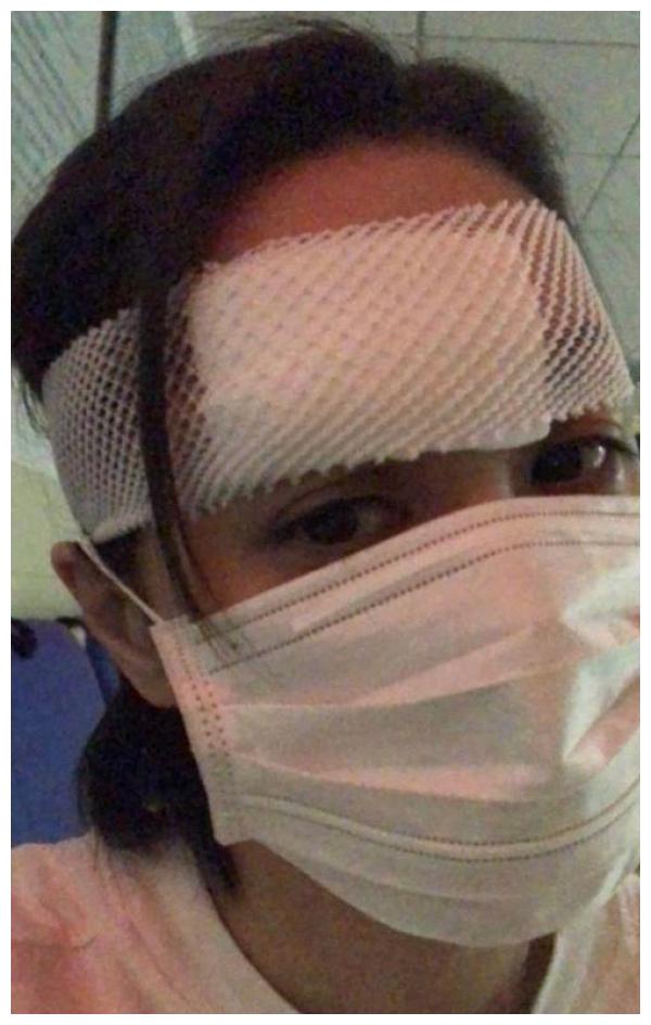 摔破头缝66针,阿娇摔伤后自拍照片曝光额头,伤口看不出来