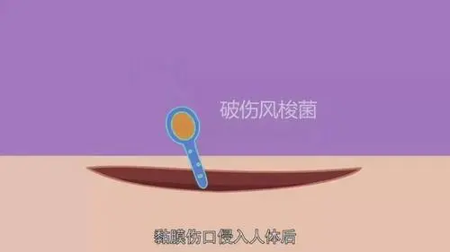 什么情况下容易患破伤风?医生是这么说的休闲区蓝鸢梦想 - Www.slyday.coM 什么情况下容易患破伤风?医生是这么说的休闲区蓝鸢梦想 - Www.slyday.coM