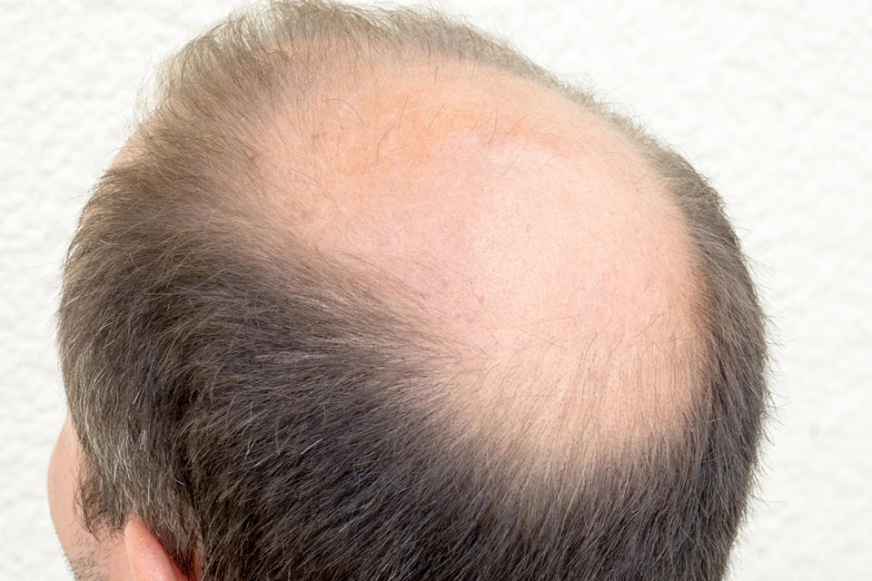 “我变秃了,也变强了”有科学根据吗?如何面对秃如其...