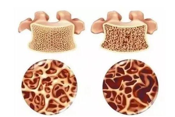 陈根新发现的成骨细胞能否拯救骨质疏松