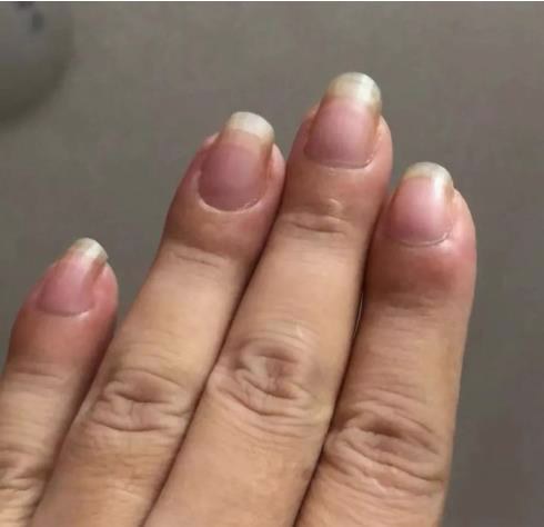 指甲若长成6种样子,可能是癌或疾病的信号,要引起重视|指甲|月牙|竖纹