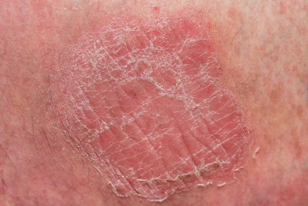 除此以外,大部分乳腺癌患者的乳房皮肤会出现一些橘皮样改变.